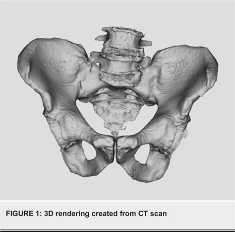 Figure 1 From A Novel Method For Correcting Pelvic Tilt On