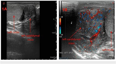 Figure 1 From Alveolar Paratesticular Rhabdomyosarcoma In An Adult