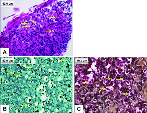 Hematoxylin And Eosin Stained Section Shows An Ulcerated Squamous