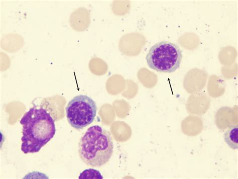 Haematology Flashcards | Quizlet 