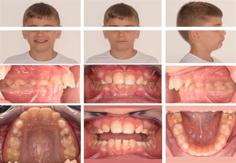 Digital Bonded Twin Block A New No Compliance Device To Treat Skeletal Class Ii Malocclusion In