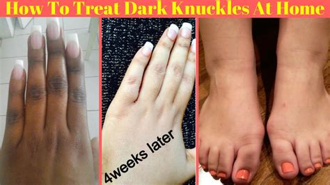 How To Whiten Dark Knuckles And Treat Wrinkles Homemade 41 OFF