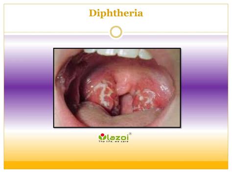 PPT - Diphtheria PowerPoint Presentation, free download - ID:7945157