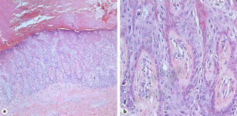 Skin Biopsy Showing Hyperkeratosis Acanthosis And Full Thickness