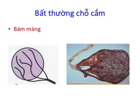 Nguy Cơ Dây Rốn Bám Màng Có ảnh Hưởng đến Thai Nhi