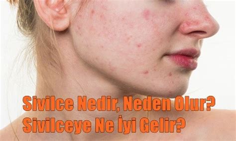 Sivilce Nedir Neden Olur Sivilceye Ne İyi Gelir BilgiTarif