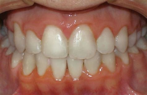 Overcrowded Teeth Before And After