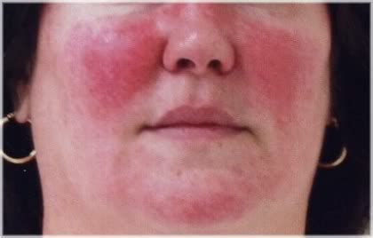 Rosacea Causes & Treatments – EruptingMind