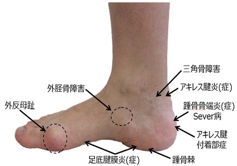 足の痛みのいろいろ ブログ｜あいたにインソールとからだの研究所