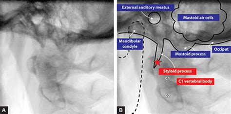 Glossopharyngeal Nerve Block Fluoroscopy