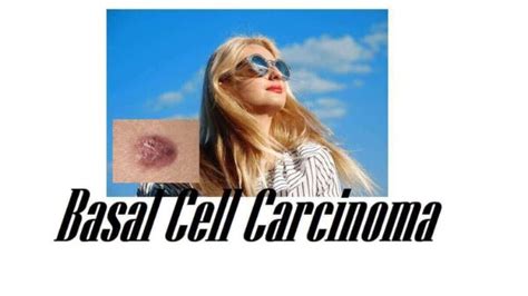 Basal Cell Carcinoma: Definition, Symptoms, 8 Risk Factors, Causes ...