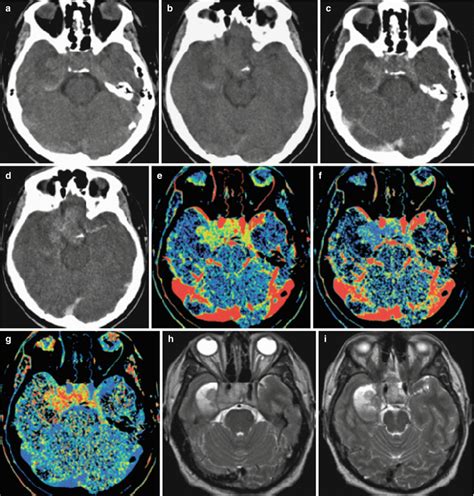 Tumors Of Sellar And Parasellar Region Radiology Key