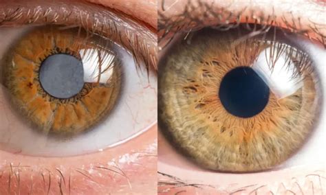 Cataracts Vs Glaucoma Symptoms Differences Treatments