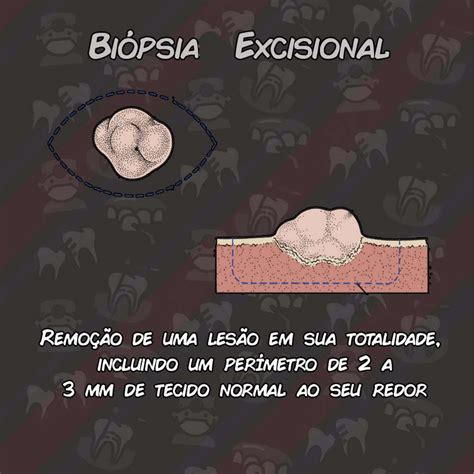 Bi Psias Em Odontologia Incisional Excisional Punch Aspira O