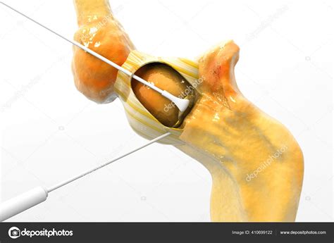 Human Knee Joint Surgery Illustration — Stock Photo © crytallight ...