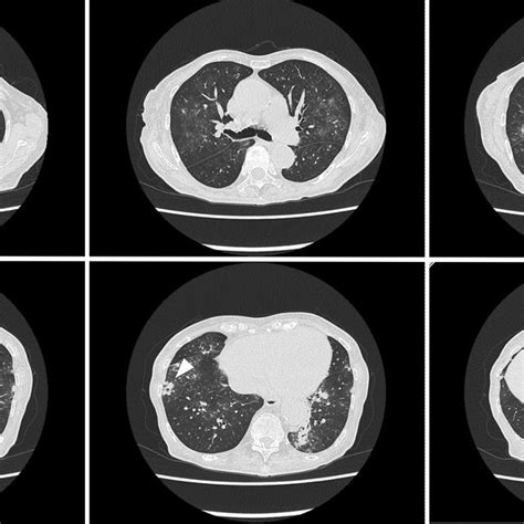 Chest Computed Tomography Scans Showing A Lung Nodule With Cavity