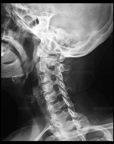 Oblique Cervical Spine Labeled Diagram Quizlet