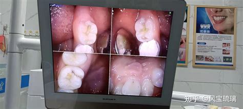 补牙到底痛不痛，蛀到牙髓的又怎么样？你知道吗？本篇文章可以对近期想要补牙的小伙伴做一个参考 知乎