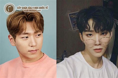 Top 5 kiểu tóc cho người hói đầu hot nhất hiện nay Cấy Ghép Tóc Tóc Y Học Quốc Tế