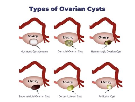 Ovarian Cysts Causes Types Symptoms And Treatments