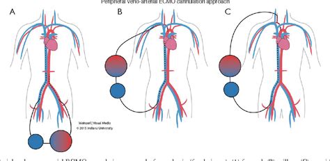 Figure 4 From Extra Corporeal Membrane Oxygenation Ecmo Review Of A