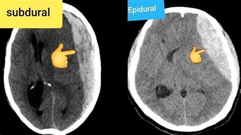 Epidural Hematoma Ct Head