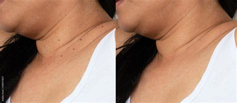 Skin texture retouched, skin tags removal before and after treatment concept Stock Photo | Adobe ...