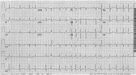 Multifocal Atrial Tachycardia - Cardiovascular - Medbullets Step 2/3