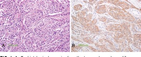 Figure From Anaplastic Meningioma Octreotide Therapy For A Case Of