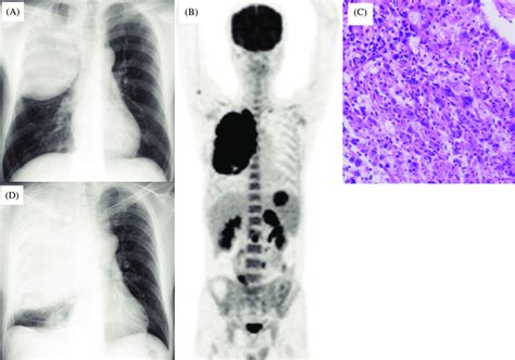 (A) Chest X-ray obtained on admission demonstrated a large mass in the ...