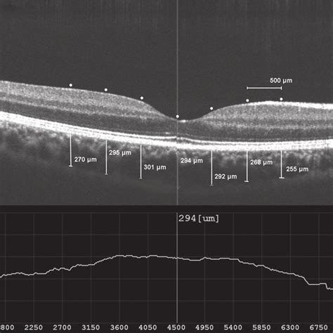 Representative Spectral Domain Optical Coherence Tomographic Image