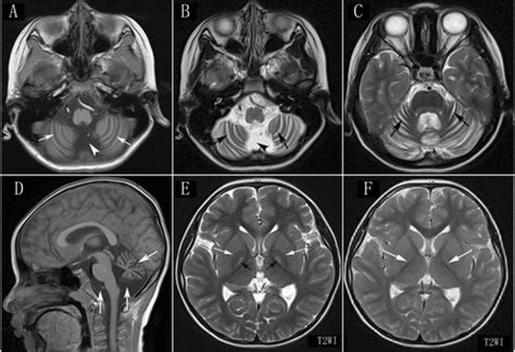 Brain MRI examination of the patient with cerebellar ataxia. a–c Axial ...