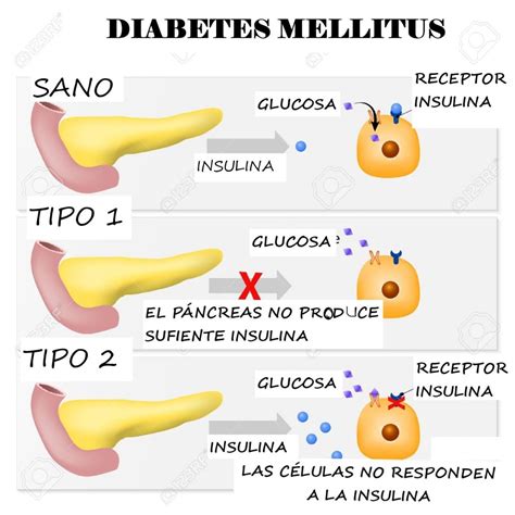 Diabetes Byournurse