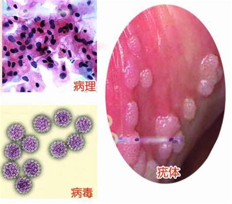 肛门长了个小肉球从外表怎样区分是痔疮还是尖锐湿疣 搜狐大视野 搜狐新闻