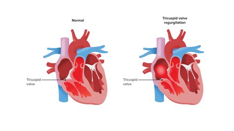 Tricuspid Regurgitation | Concise Medical Knowledge