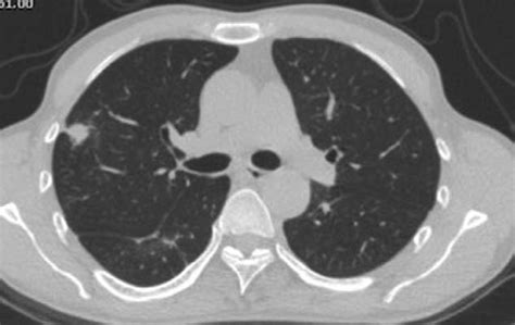 Representative Case With Pulmonary Cryptococcosis Showed A Nodule Download Scientific Diagram