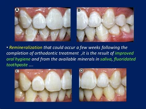 White Spot Lesions