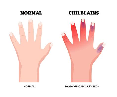 normal  chilblains hand condition symptoms medical illustration