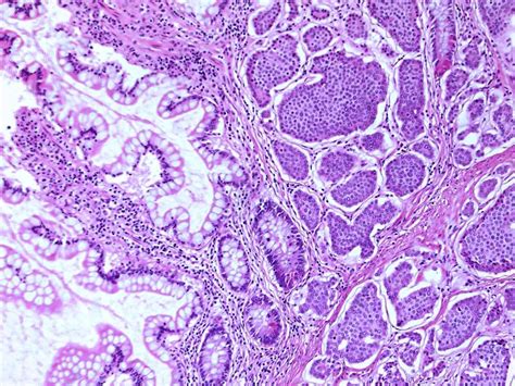 Terminal Ileum Carcinoid Well Differentiated Neuroendocrine Tumor