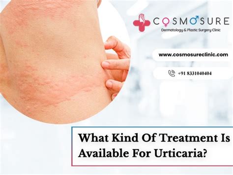 What Kind Of Treatment Is Available For Urticaria | Cosmosure Clinic