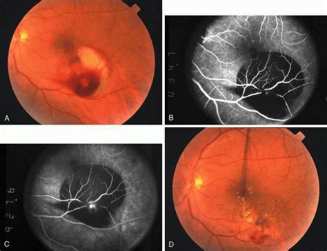 Retinal Arterial Macroaneurysms Ento Key