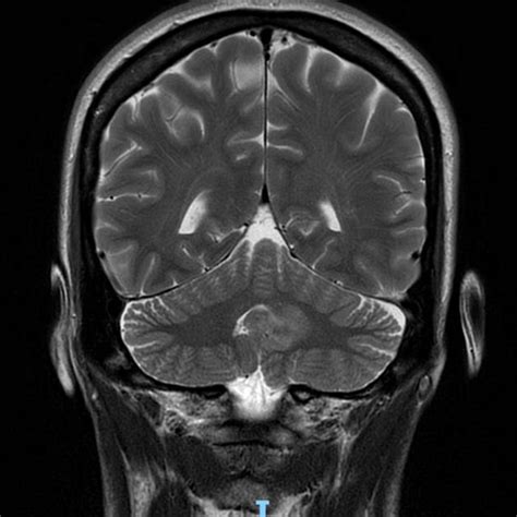 Mri Show A Hyperintense Left Cerebellar Focal Lesion On T2‐weighted