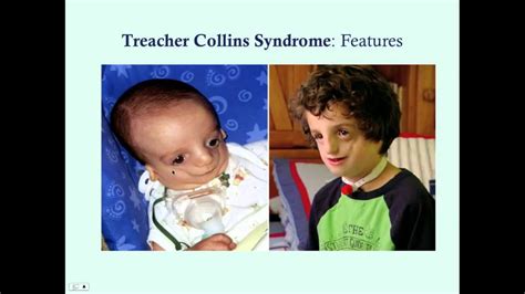 Treacher Collins Syndrome Crash Medical Review Series Youtube