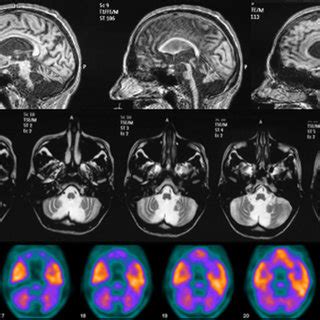 Gertsmann-straussler-scheinker Syndrome - Captions Profile