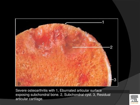 Ppt Musculoskeletal Block Pathology Disease Of Joints Powerpoint