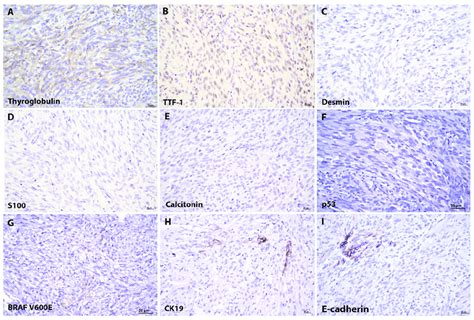 Immunohistochemical Features Of Papillary Thyroid Carcinoma With