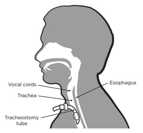 Laryngotracheal Separation Surgery Day 1 — Kim Rankin