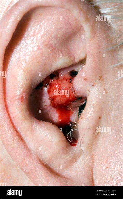 Close Up Of The Ear Of An Elderly Male Patient Showing Squamous Cell