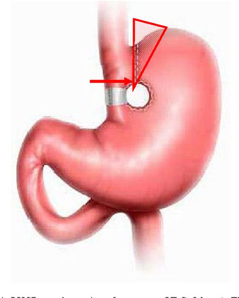 Figure 1 from Short-and Long-Term Outcomes of Vertical Banded ...