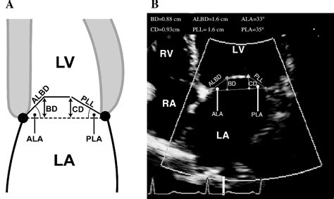 Preoperative Posterior Leaflet Angle Accurately Predicts Outcome After